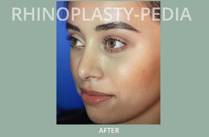 female rhinoplasty patient before and after photo 8