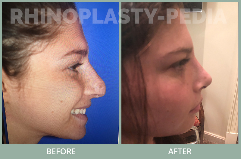 rhinoplasty female patient before and after photo set 58