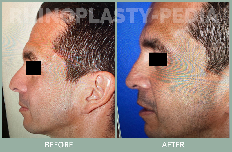 male rhinoplasty patient before and after photo 57