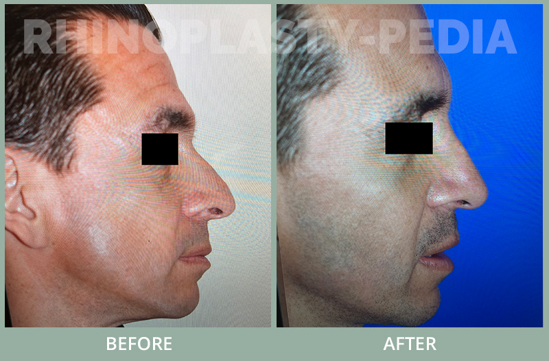 male rhinoplasty patient before and after photo 57