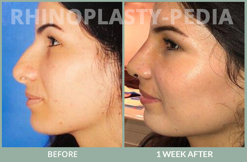 rhinoplasty female patient before and after photo set 67