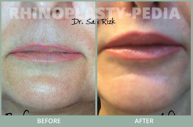 FEmale rhinoplasty patient before and after photo 83