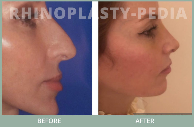 rhinoplasty female patient before and after photo 1