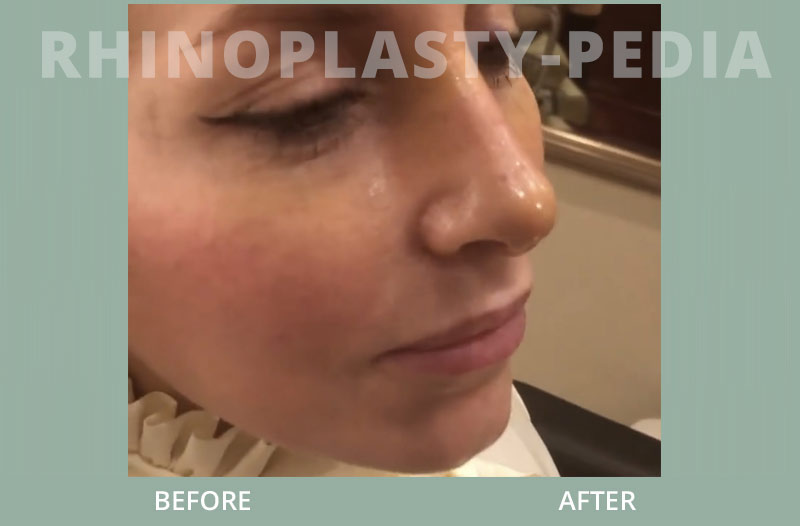rhinoplasty female patient before and after photo 2