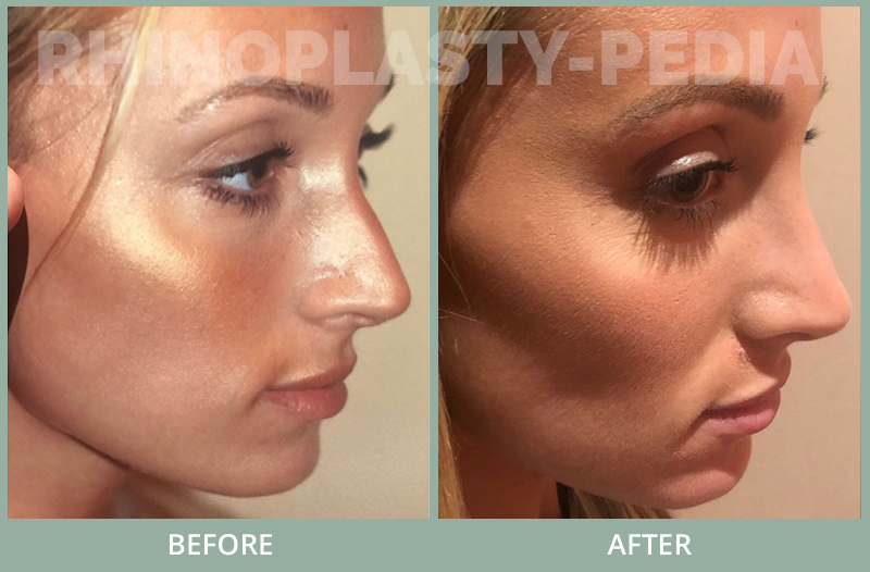 rhinoplasty female patient before and after photo set 109