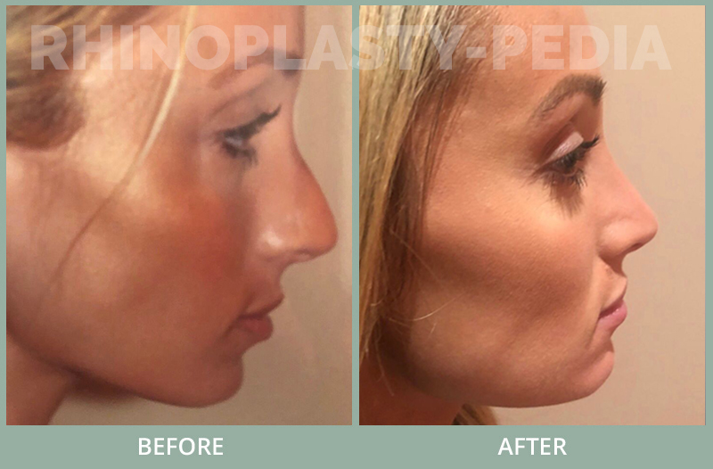 rhinoplasty female patient before and after photo set 110