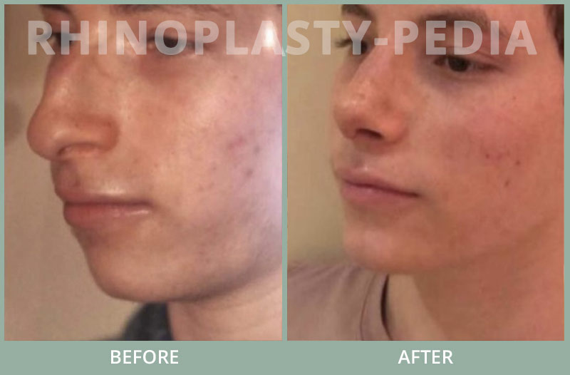 male rhinoplasty patient before and after photo 81