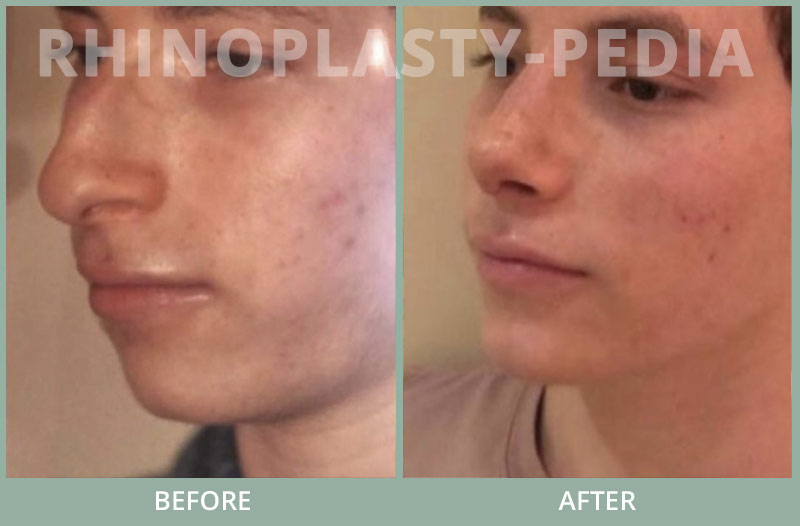 rhinoplasty male patient before and after photo set 81