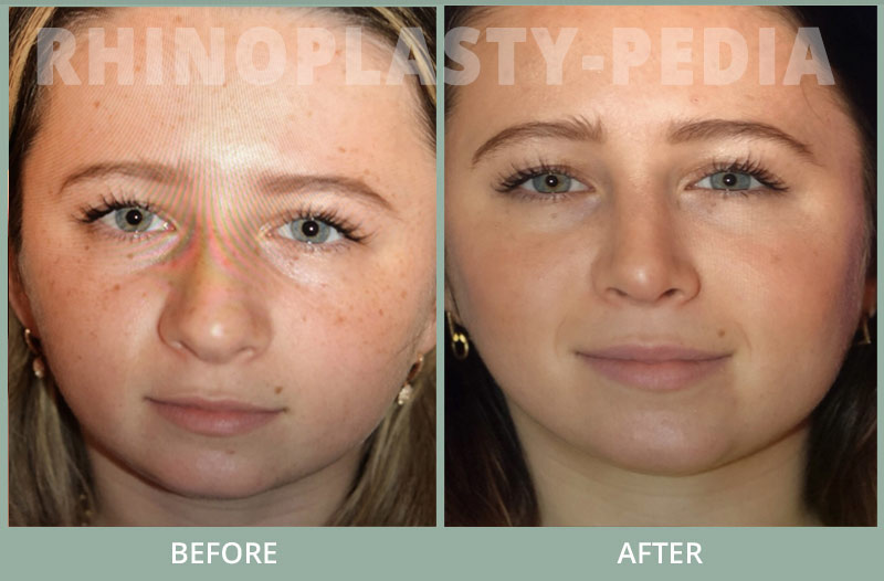 rhinoplasty female patient before and after photo set 111