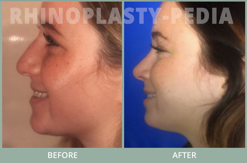 rhinoplasty female patient before and after photo set 112