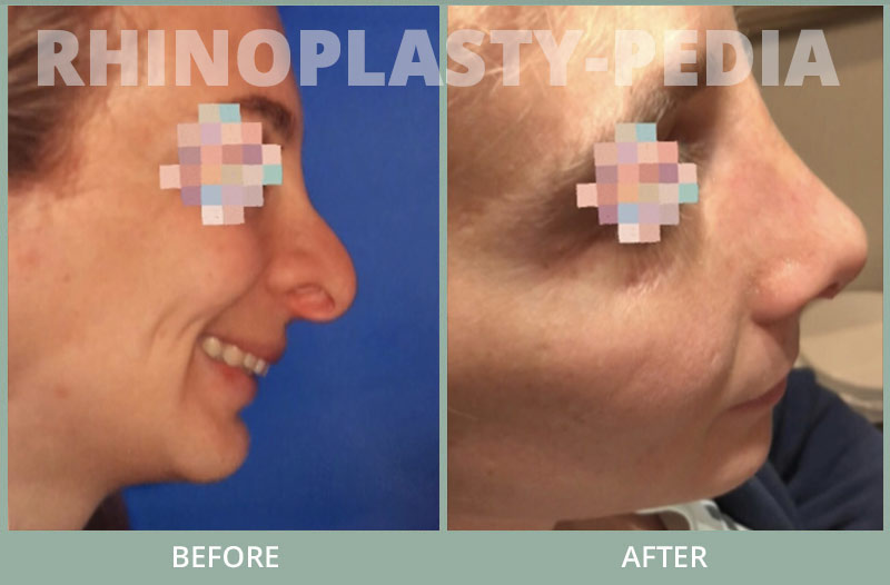 female rhinoplasty patient before and after photo 35