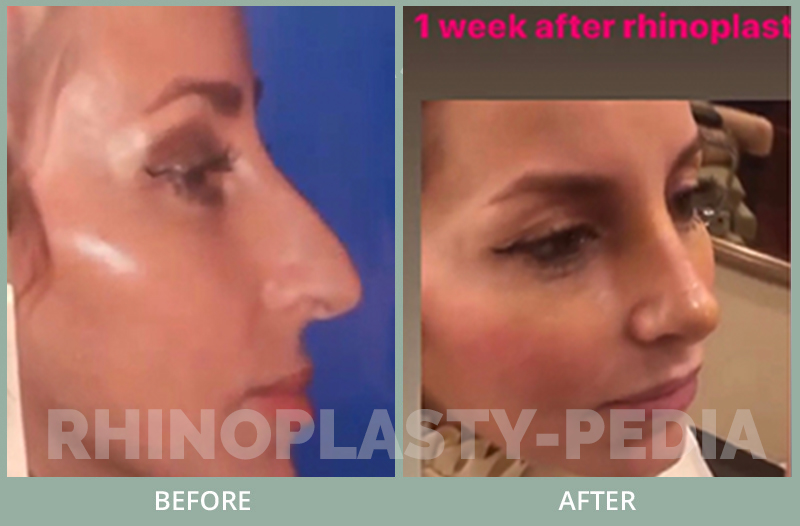 rhinoplasty female patient before and after photo set 111