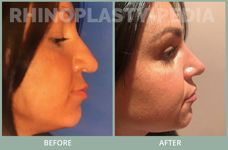 rhinoplasty female patient before and after photo set 112