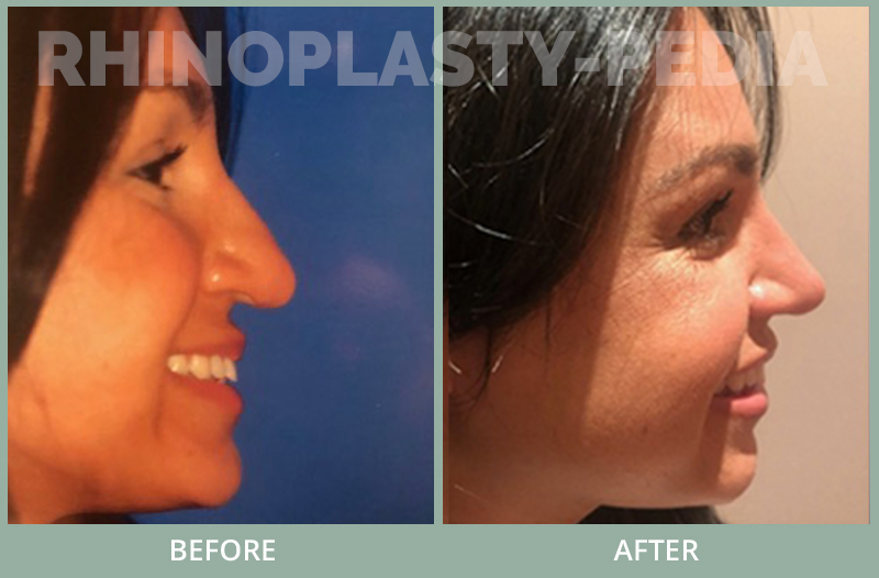 Patient is 6 months after revision rhinoplasty #3 with irradiated rib bank cartilage to support her tip and lift droppy tip . She previously had septum & ear cartilage which did not work .