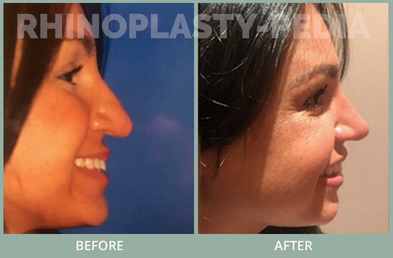 rhinoplasty female patient before and after photo set 112