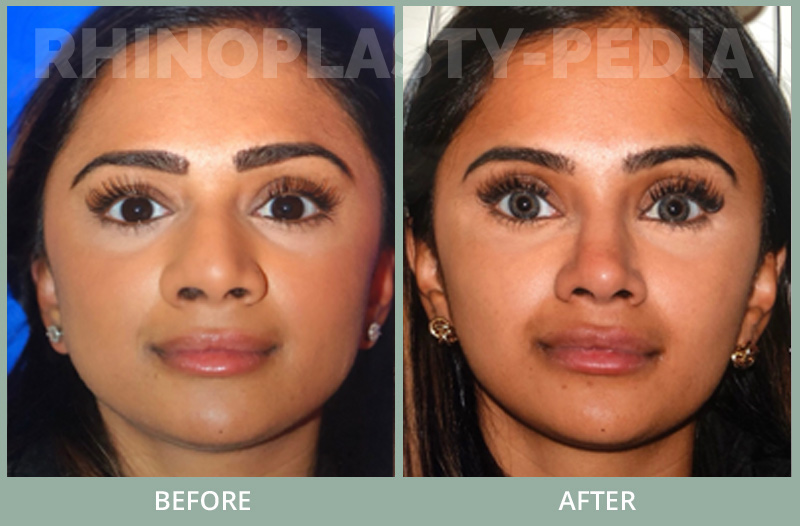 30 yo physician underwent rhinoplasty open with alar base reduction and grafts shown 1 year post, tip and nostrils narrowed and supported and bump removed.