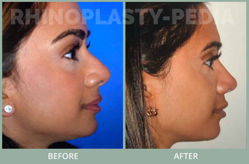30 yo physician underwent rhinoplasty open with alar base reduction and grafts shown 1 year post, tip and nostrils narrowed and supported and bump removed.
