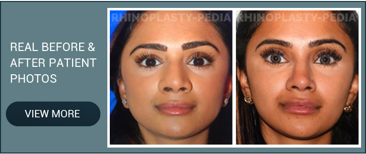 Indian rhinoplasty patient before and after photo
