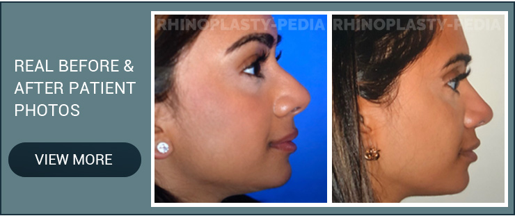 latino and hispanic rhinoplasty male patient before and after photo