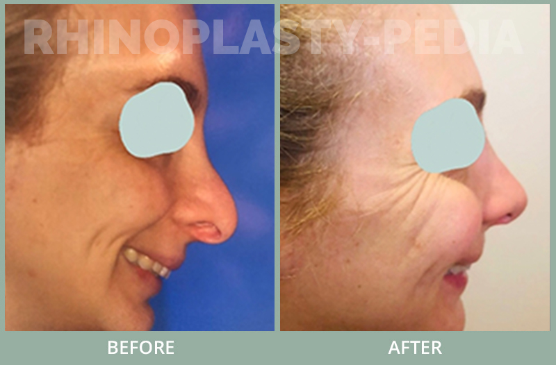 History - 30 yo doctor shown 6 months post revision rhinoplasty ( open) with irradiated rib cartilage to remove pollybeak and repair hanging columella.