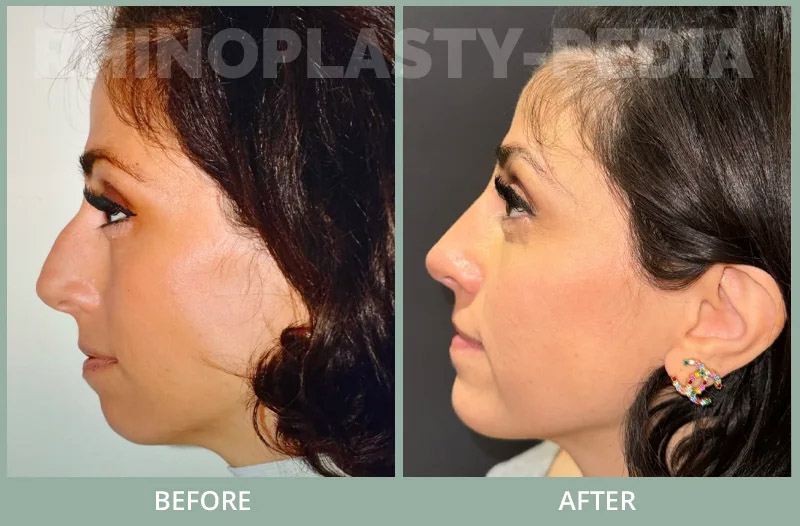 Patient is 4 months after rhinoplasty / chin implant. Note jawline / nose balance by removing bump and augmenting chin creating a better jawline.