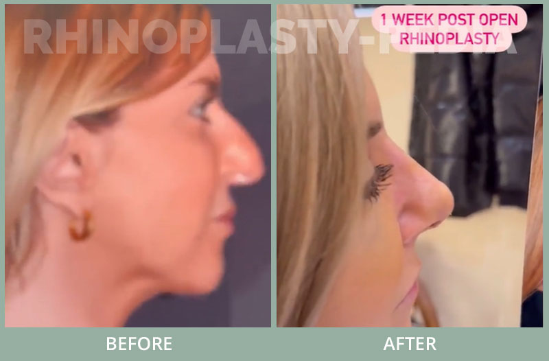 Patient sent her postop pictures 2 years after rhinoplasty compared to same time before