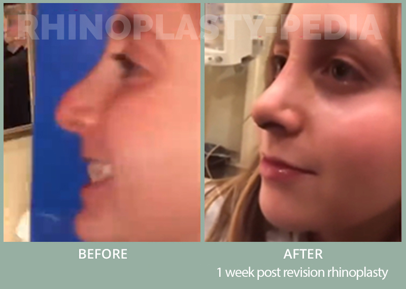 1 week post revision rhinoplasty