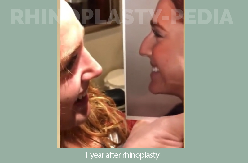 1 year after rhinoplasty