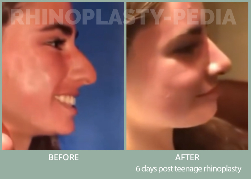 6 day post teenage Rhinoplasty