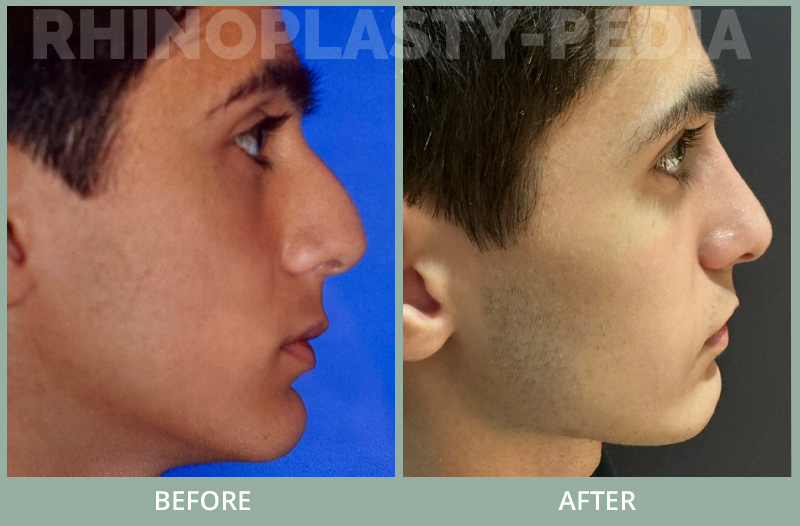 Teenage patient underwent conservative septoplasty/ rhinoplasty to remove bump and repair breathing